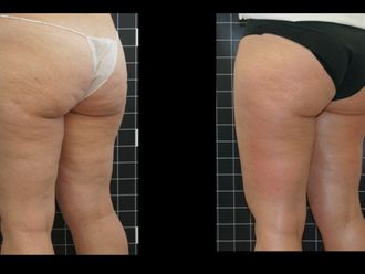 Celulitis antes y después - 873441