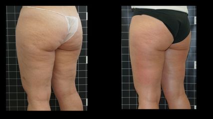 Eliminar celulitis
