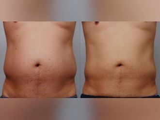Criolipólisis antes y después - 880080