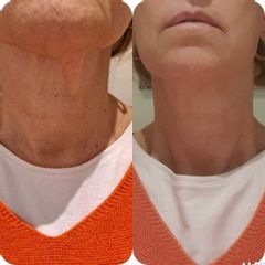 Eliminación de arrugas - Dra. Esther Subirachs