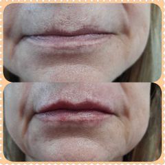 Aumento de labios - Dra. Esther Subirachs