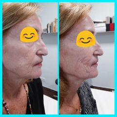 Rejuvenecimiento facial - Dra. Esther Subirachs
