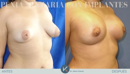 Mastopexia - Kirurgio Medical Group