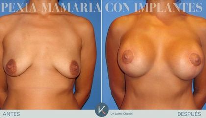 Mastopexia - Kirurgio Medical Group