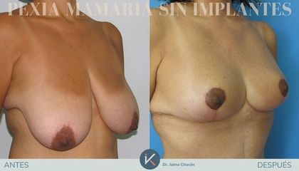 Mastopexia - Kirurgio Medical Group