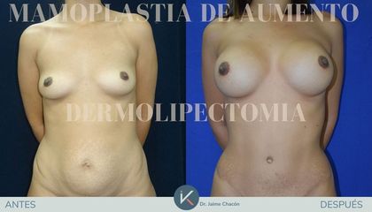 Aumento de pecho - Kirurgio Medical Group