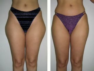 Antes y después mesoterapia Aqualix