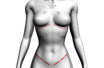 Lipoescultura