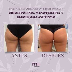 Criolipólisis - Clínica Amédic