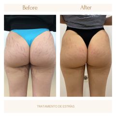 Eliminación de estrías - Clínica Amédic