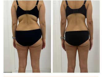 Mesoterapia antes y después - 861668