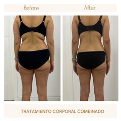 Mesoterapia - Clínica Amédic