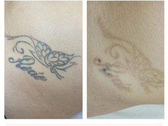 Eliminación de tatuajes antes y después - 861669