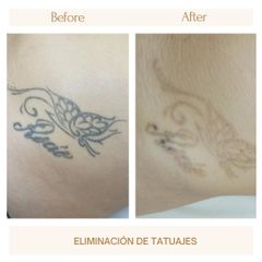 Eliminación tatuajes - Clínica Amédic