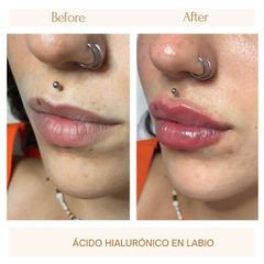 Aumento labios - Clínica Amédic
