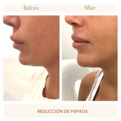 Reducción de papada - Clínica Amédic