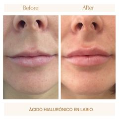 Aumento labios - Clínica Amédic