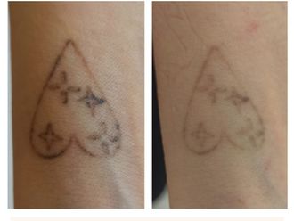 Eliminación de tatuajes antes y después - 861674