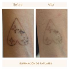 Eliminación tatuajes - Clínica Amédic