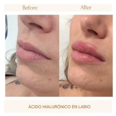 Aumento labios - Clínica Amédic