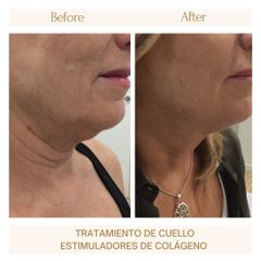 Tratamiento de cuello - Clínica Amédic