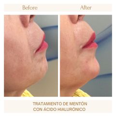 Aumento de mentón - Clínica Amédic