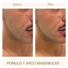 Aumento de pómulos - Clínica Amédic