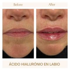 Aumento labios - Clínica Amédic