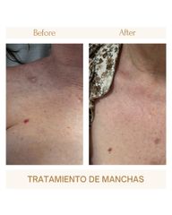Tratamiento de manchas
