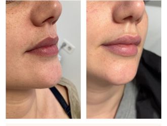 Aumento labios antes y después - 874470