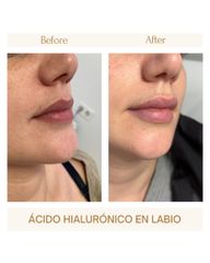 Aumento de labios