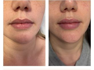 Aumento labios antes y después - 874471