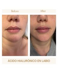 Aumento de labios