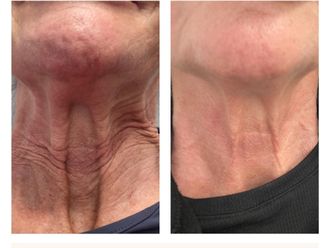 Radiofrecuencia facial antes y después - 874472