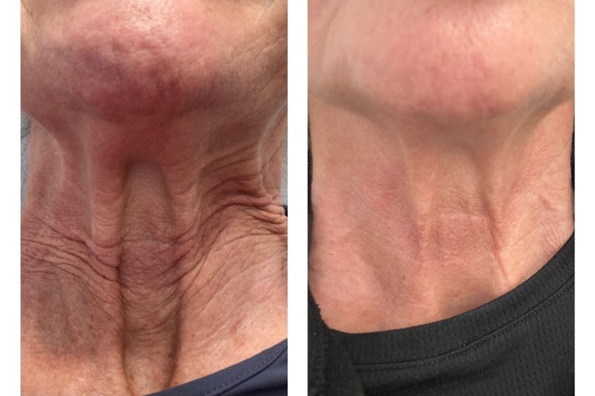 Radiofrecuencia facial antes y después - 874472