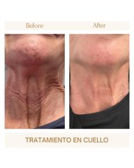 Tratamiento en cuello