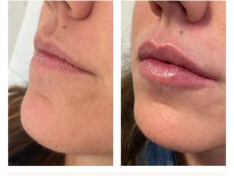 Aumento labios antes y después - 874473