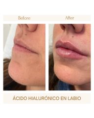 Aumento de labio