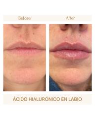 Aumento de labios