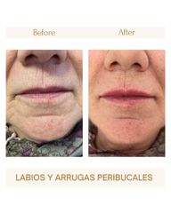 Labios y arrugas peribucales