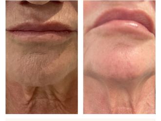 Rejuvenecimiento facial antes y después - 874477