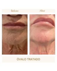 Ovalo tratado