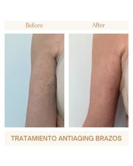 Tratamiento antiaging brazos