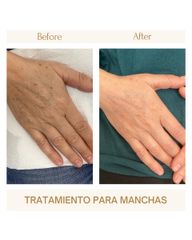 Tratamiento para manchas