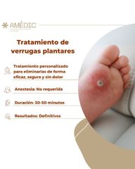 Tratamiento de verrugas plantares