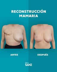 Reconstrucción mamaria - Clínica Sanz
