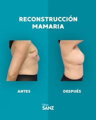 Reconstrucción mamaria - Clínica Sanz