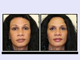 Antes y después Lipofilling facial con liposucción cervical
