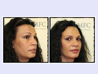 Antes y después Lipofilling facial liposucción cervical, rejuvenecimiento facial