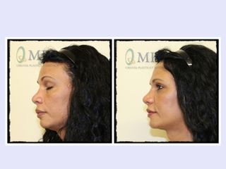 Antes y después Lipofilling facial, liposucción cervical, rejuvenecimiento facial